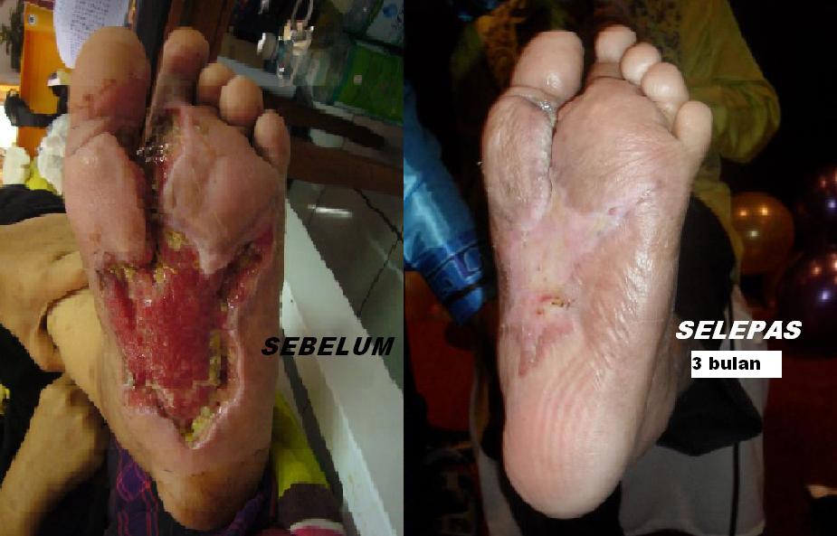Image result for penyakit kencing manis sebelum dan selepas